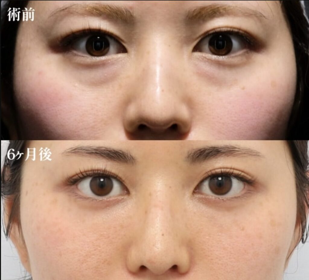 裏ミッドフェイスリフト-Pono式PRP皮膚再生療法（目の下）