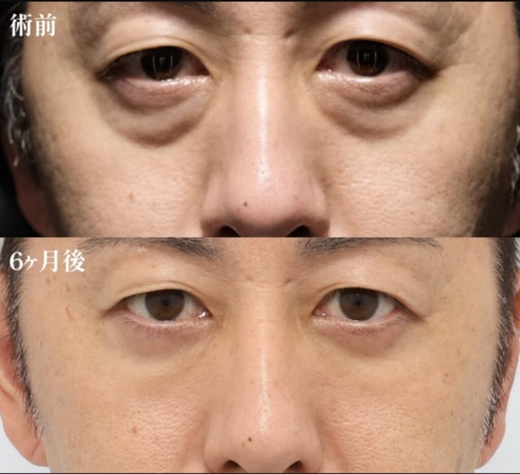 裏ミッドフェイスリフト-Pono式PRP皮膚再生療法（目の下）