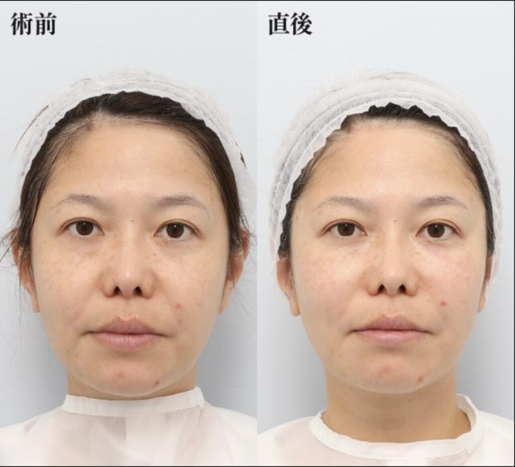 中顔面バーティカルリフト（糸リフト6本）