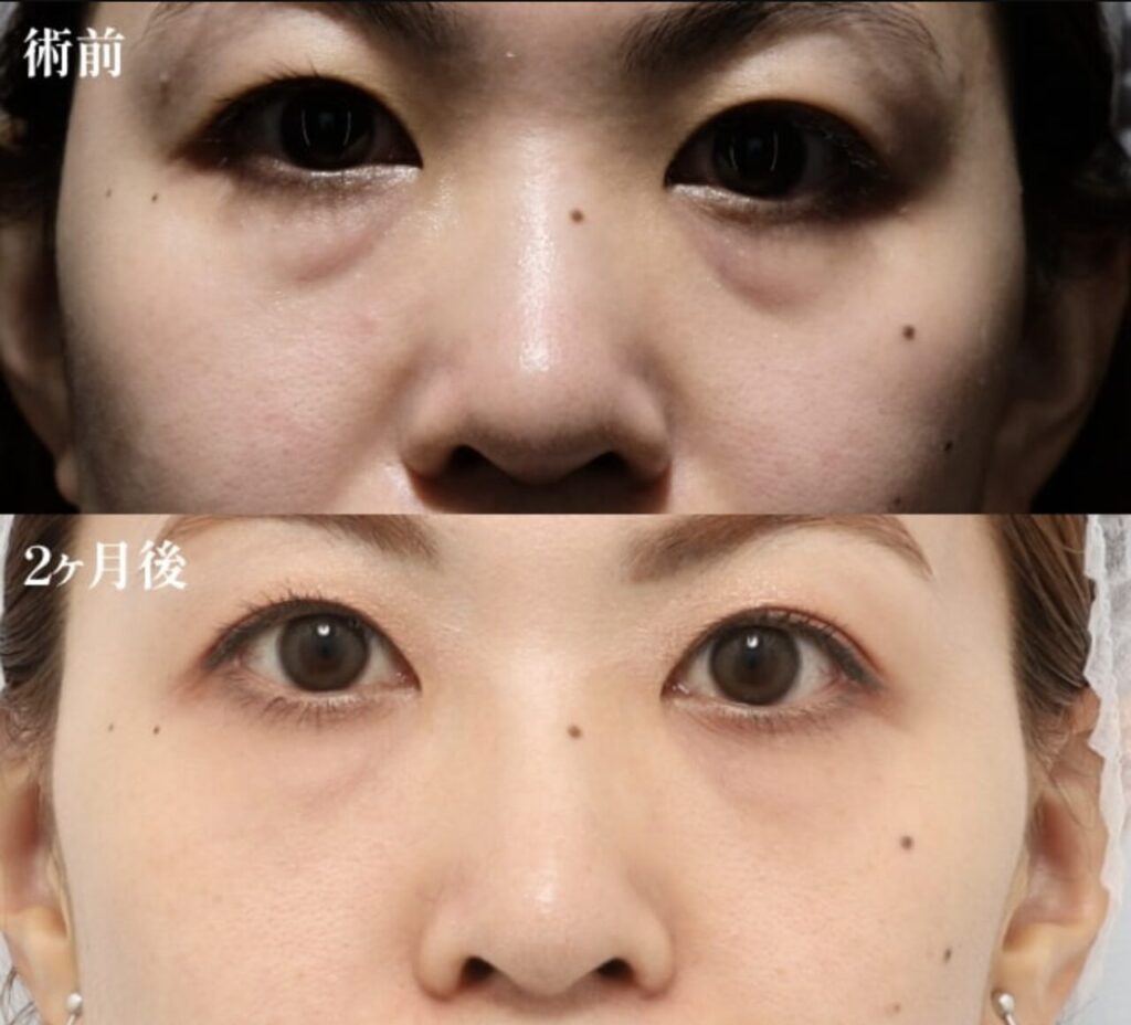 PRPF療法（目の下、ゴルゴライン）