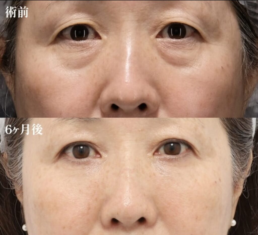 裏ミッドフェイスリフト-二重埋没法2ループ