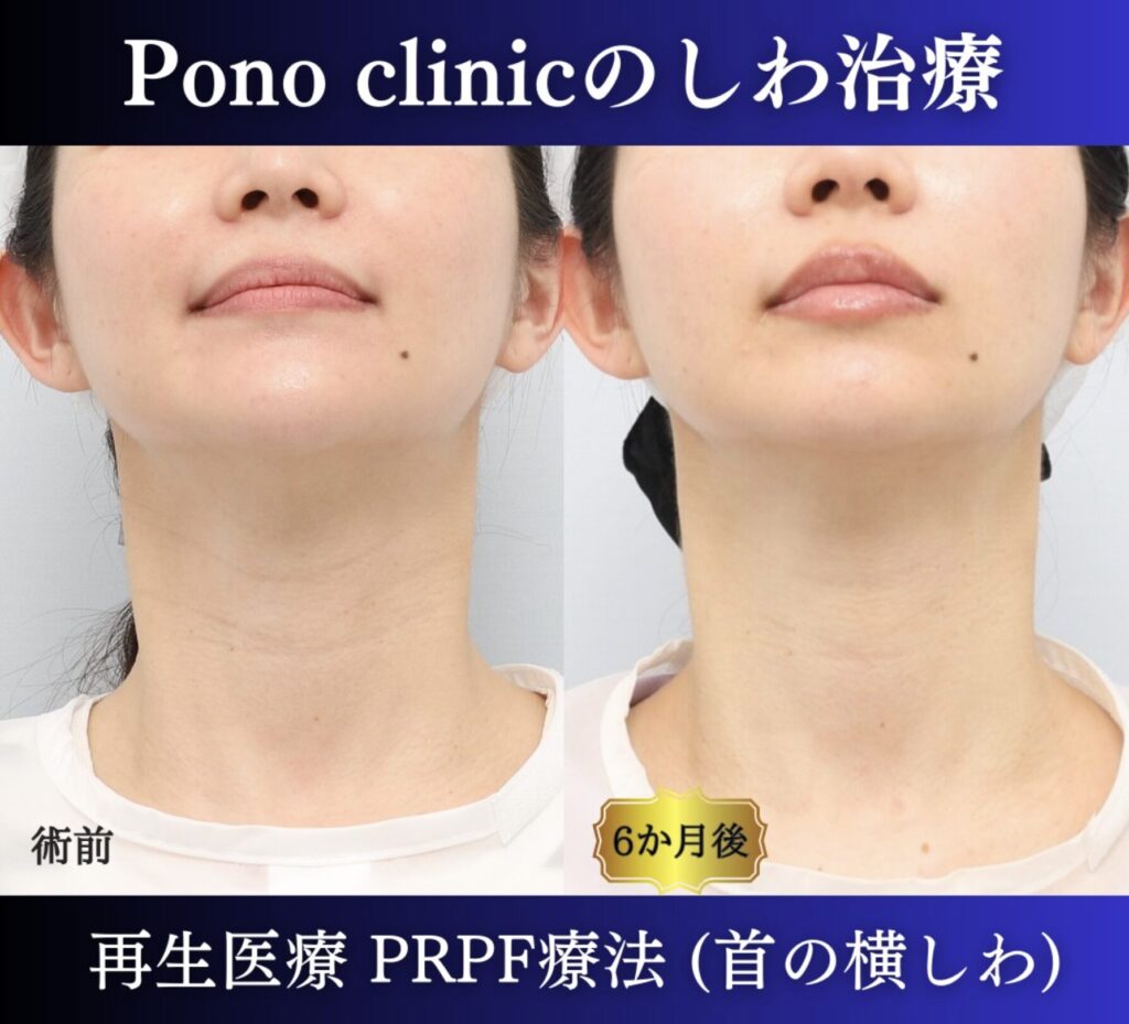 PRPF療法首の横シワ改善の症例、上