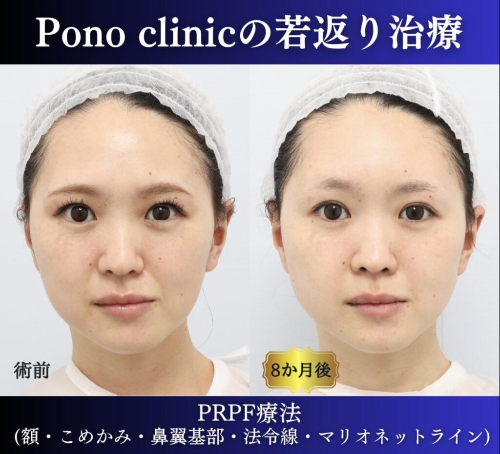 PRPF療法（額こめかみ鼻翼基部法令線マリオネットライン）の症例、8M