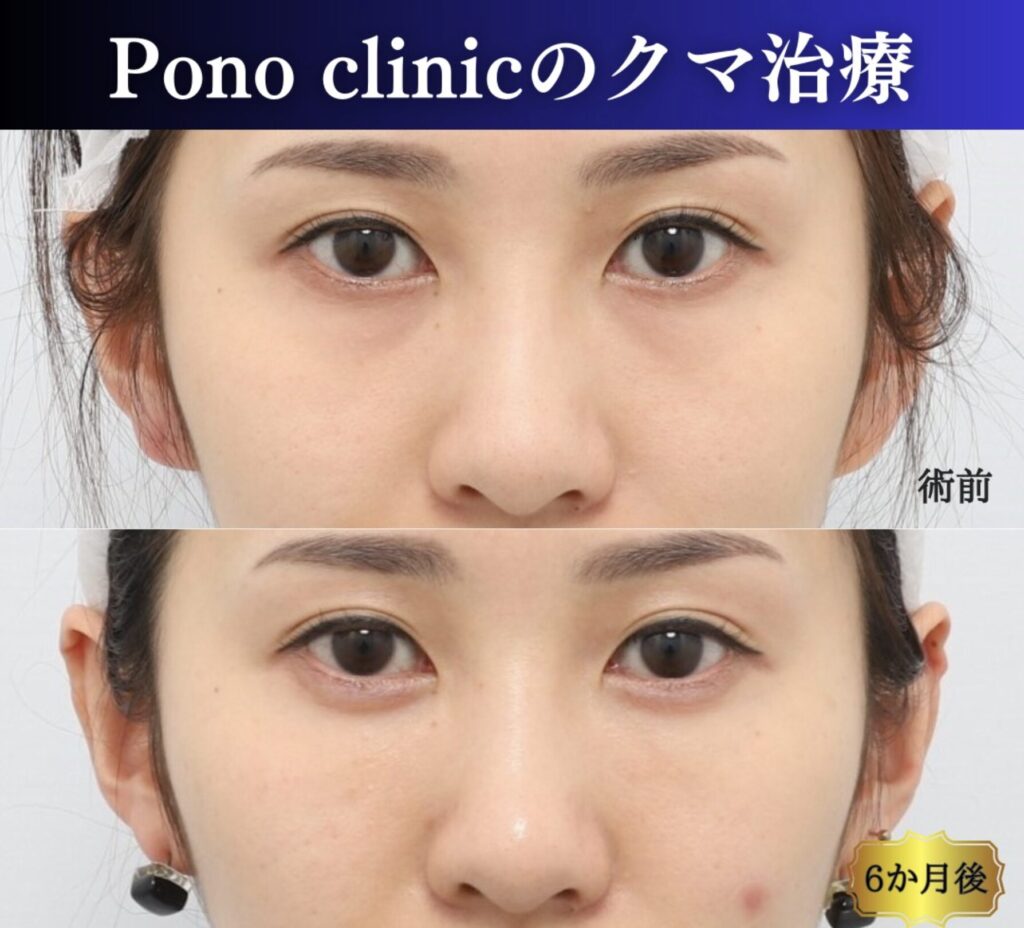 クマ治療の裏ミッドフェイスリフト、PRPF療法の症例、正面