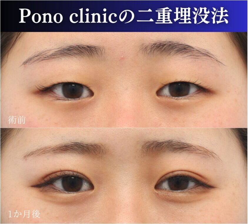 二重埋没法2ループの症例、正面