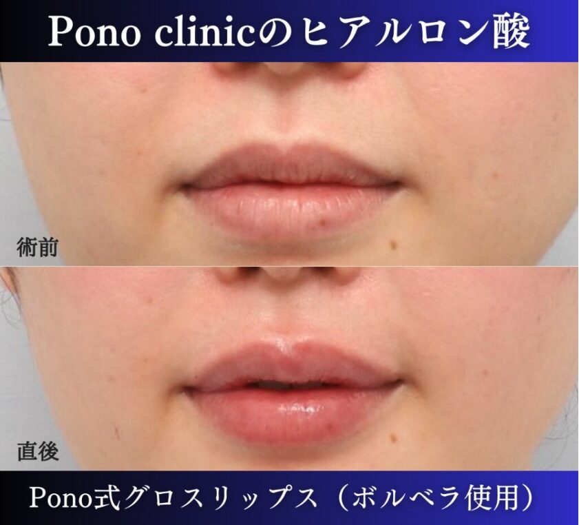 唇ヒアルロン酸注入の症例、直後 (3)