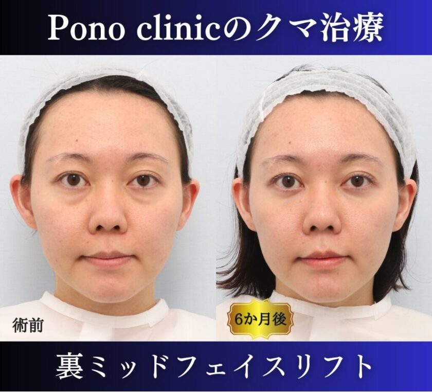 クマ取り東京、裏ミッドフェイスリフトの症例、半年正面