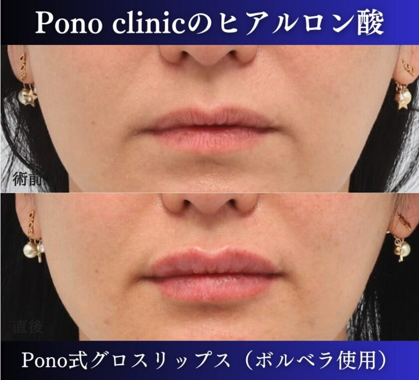 唇ヒアルロン酸注入の症例、直後 (4)