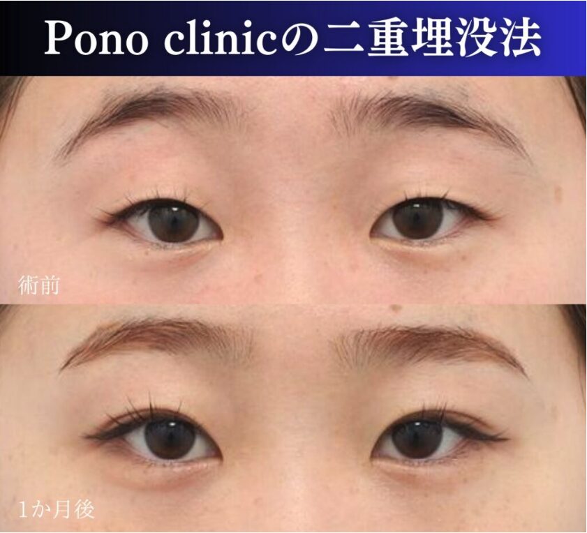 二重埋没法2ループの症例、前