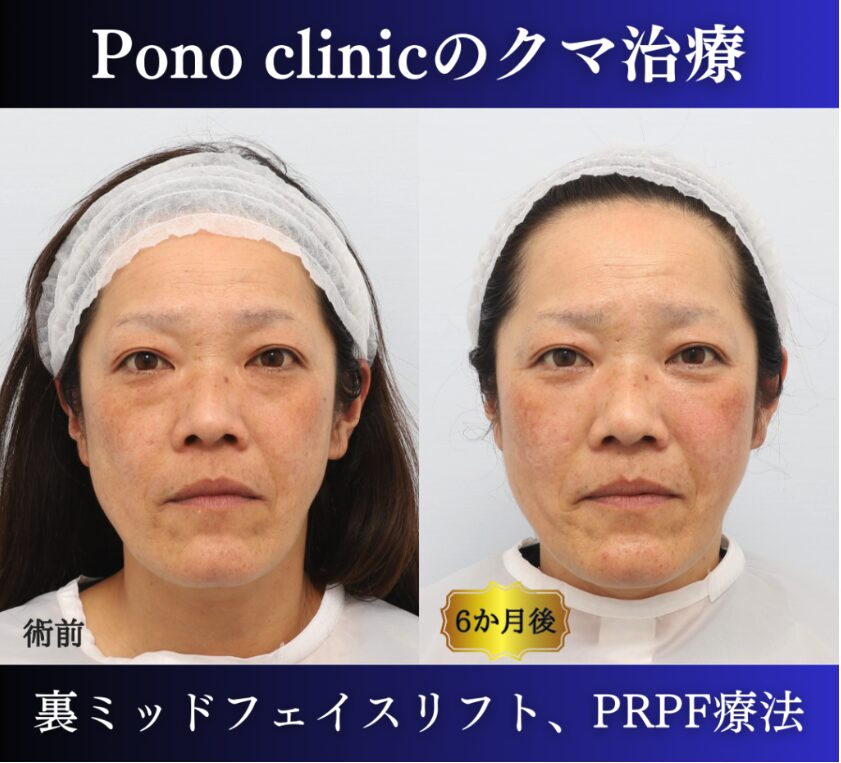 クマ取り東京、裏ハムラ、ミッドフェイスリフト、頬のPRPF療法の症例 (1)