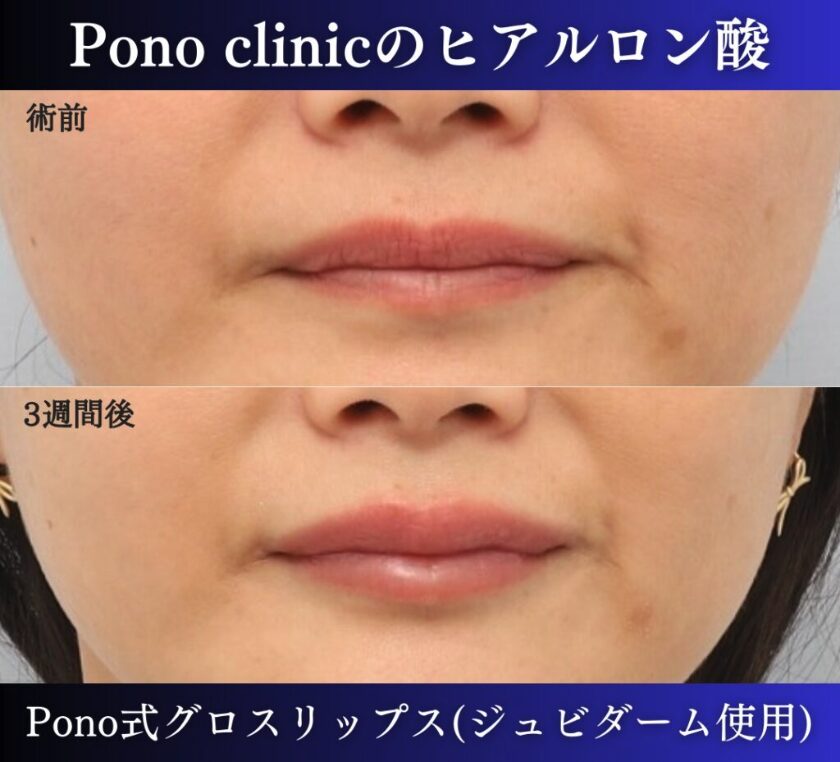 唇ヒアルロン酸注入の3週間後の症例