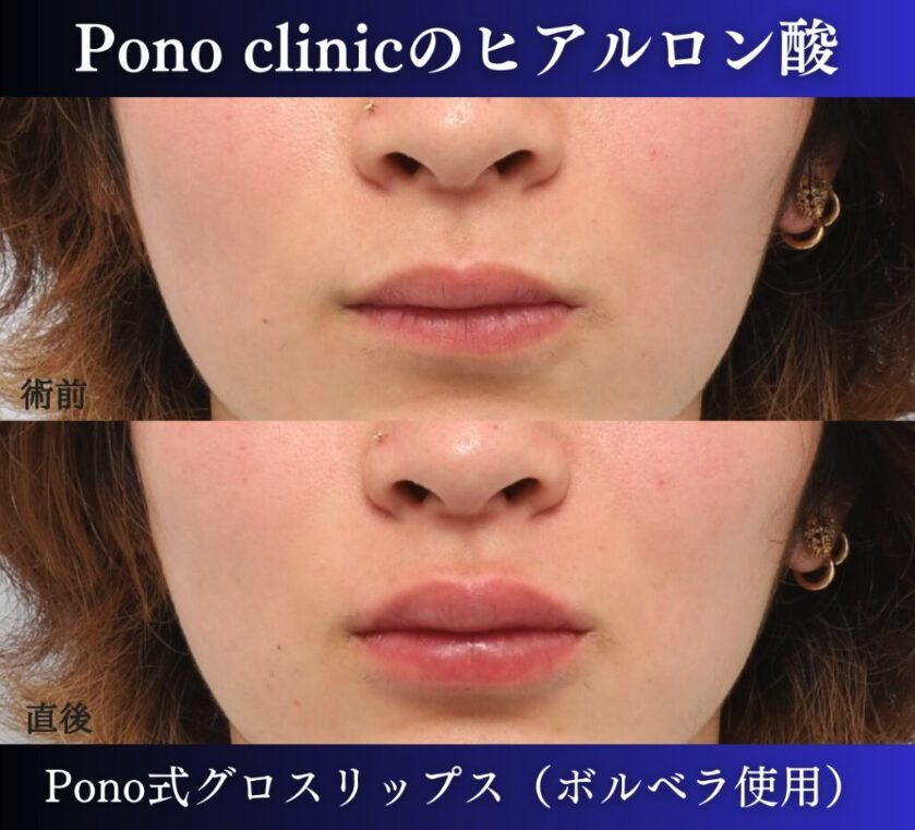 唇ヒアルロン酸注入の症例、直後 (11)