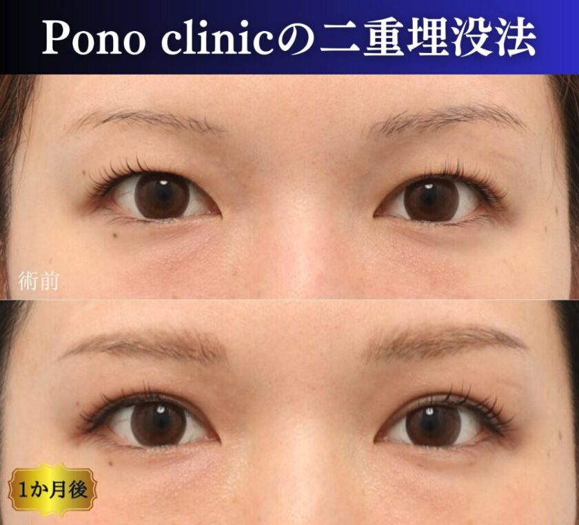 二重埋没法の症例、1M