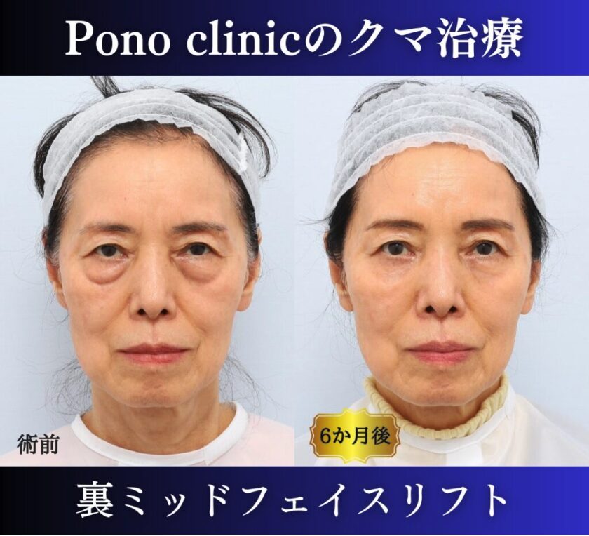 クマ取り東京、裏ミッドフェイスリフト70代の症例、半年後正面