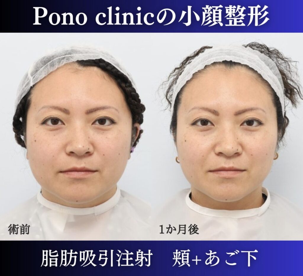 脂肪吸引注射頬+あご下の症例、1か月後正面