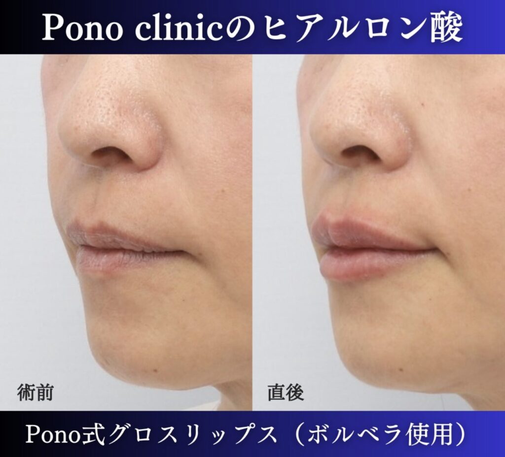 唇ヒアルロン酸注入、50代の症例 (1)