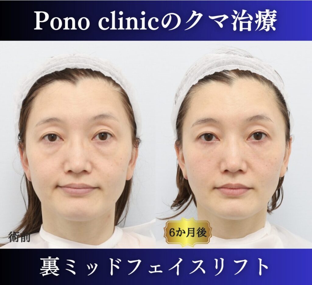 クマ取り東京、40代のクマ治療、裏ミッドフェイスリフトの症例 (1)