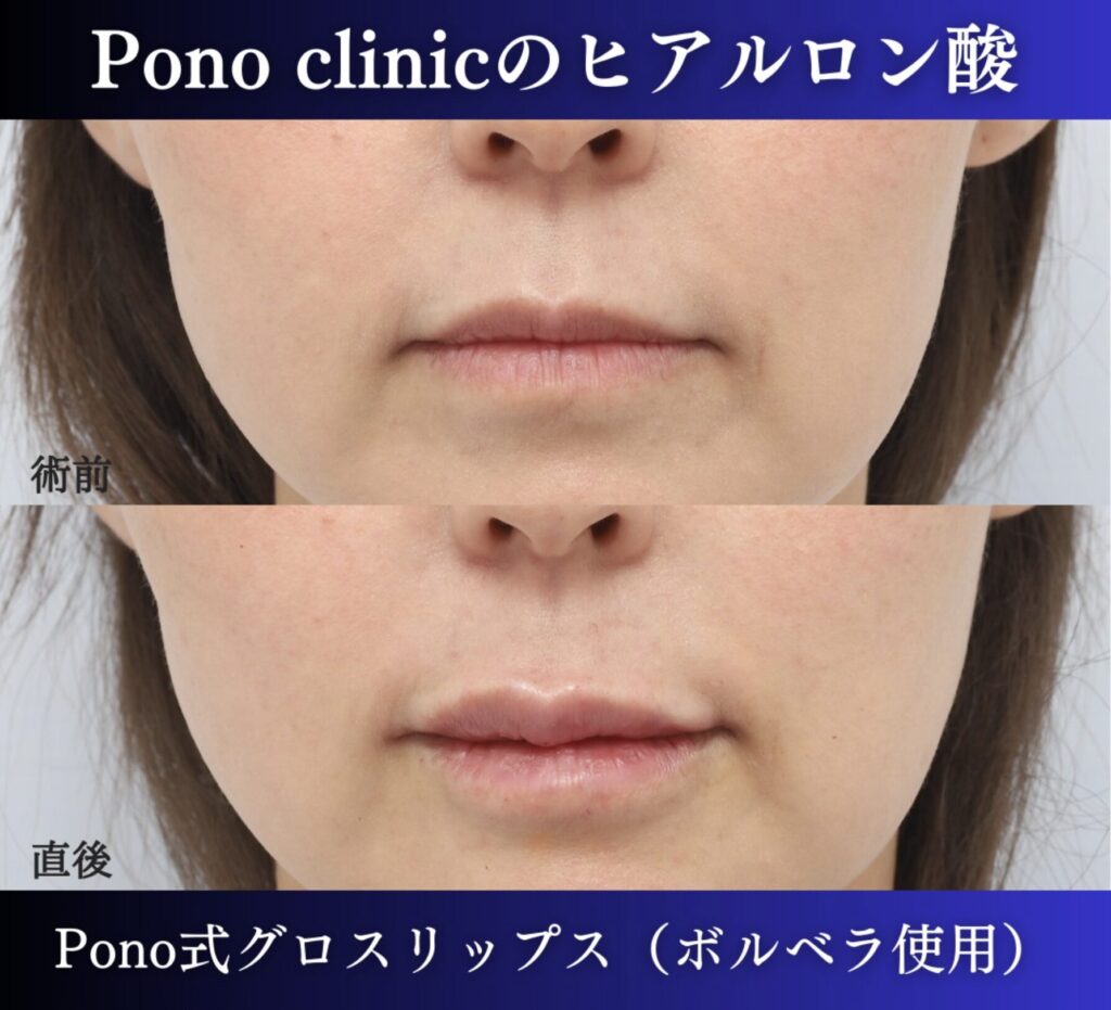 唇ヒアルロン酸注入、40代 (3)