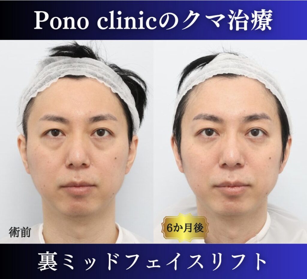 クマ取り東京、裏ミッドフェイスリフト、40代男性 (1)