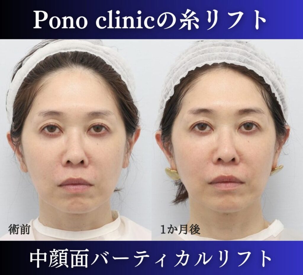 中顔面バーティカルリフト（糸リフト）、40代の症例 (2)