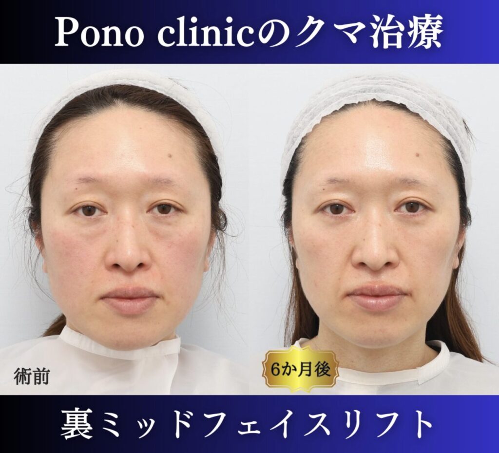 クマ取り東京、40代女性、クマ治療（裏ミッドフェイスリフト） (6)