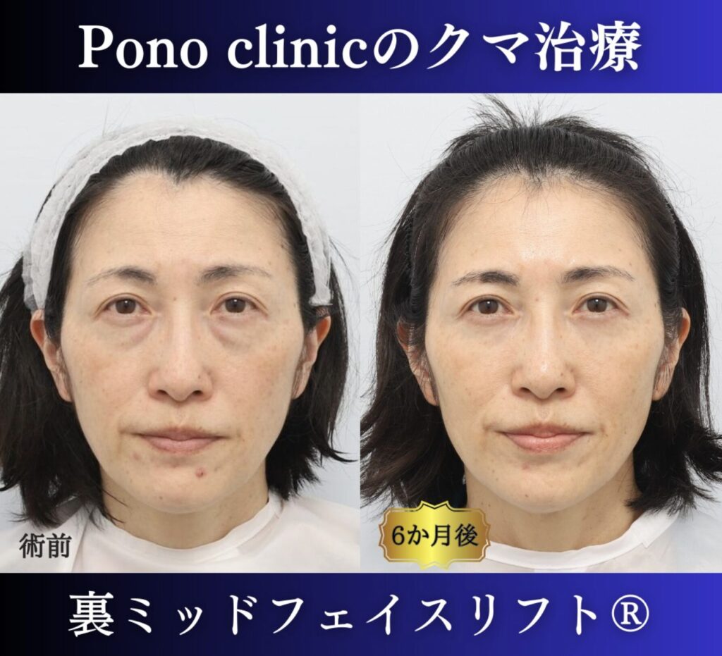 50代女性、クマ取り東京、裏ミッドフェイスリフト® の症例 (7)