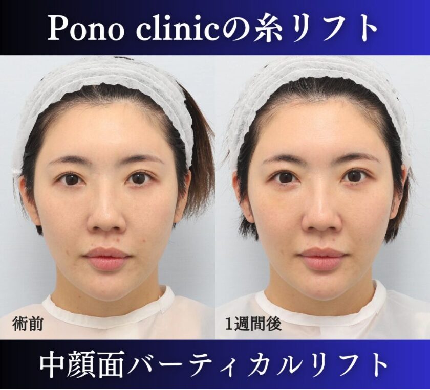 糸リフト、中顔面バーティカルリフトの症例、30代女性 (3)