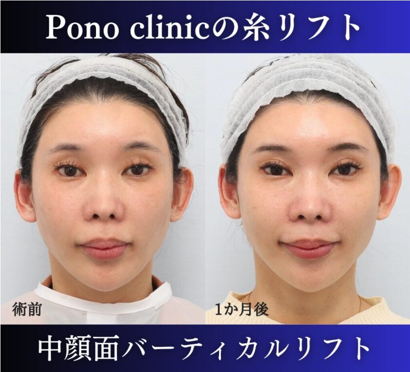 中顔面バーティカルリフト、糸リフト40代の症例 (1)