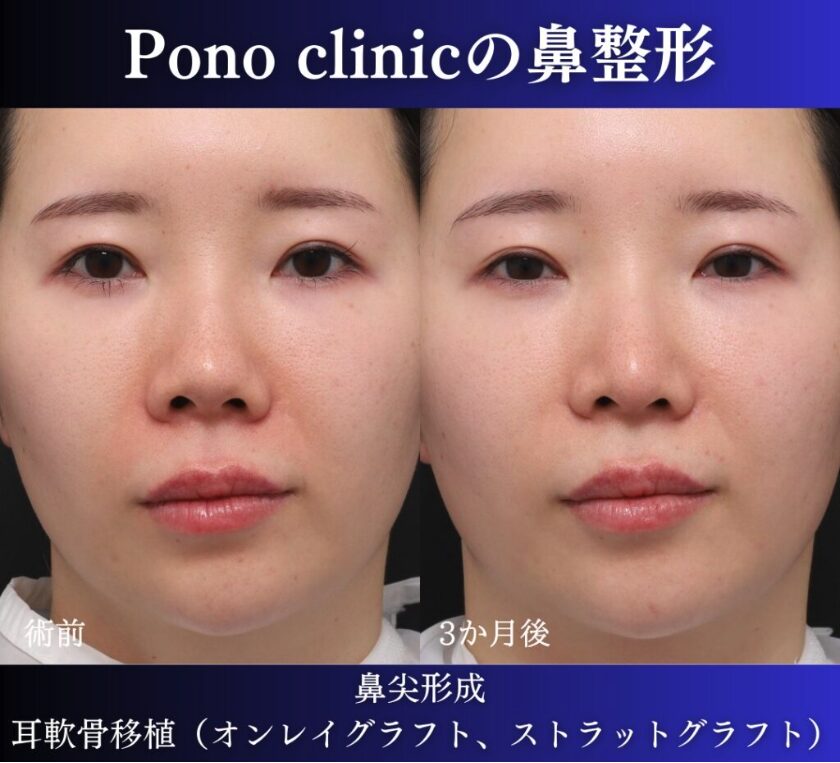 鼻尖形成、軟骨移植の症例 (4)