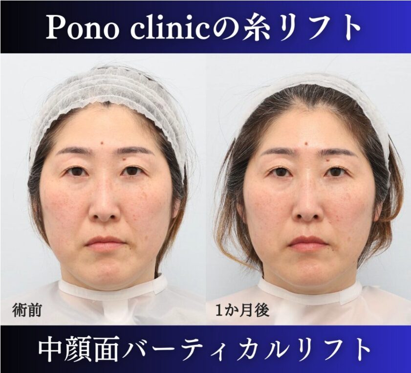 中顔面バーティカルリフト、40代糸リフトの症例 (3)