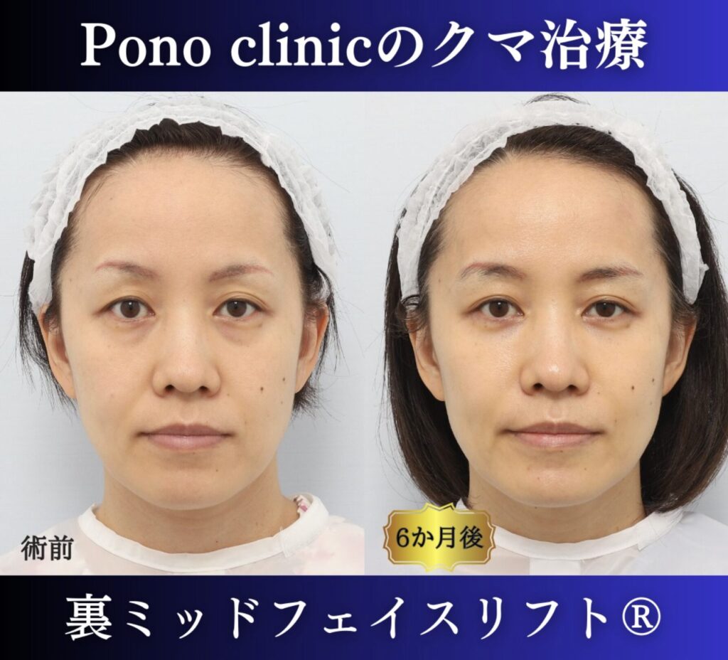 クマ取り東京、裏ミッドフェイスリフト、法令線治療、PRPF、40代女性の症例 (7)