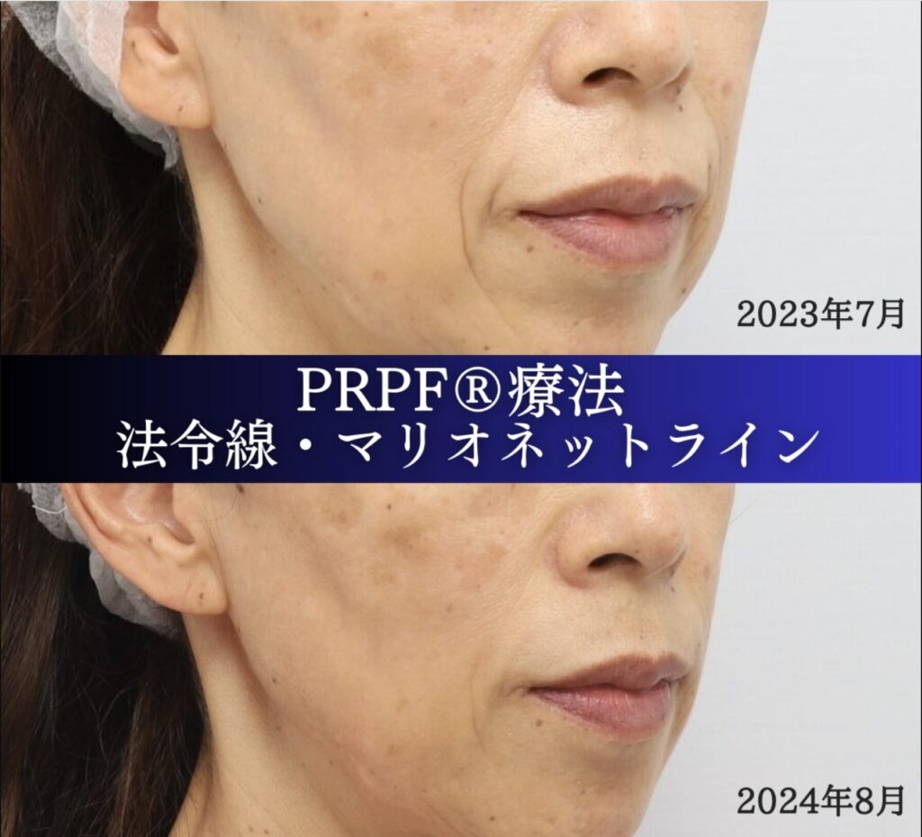 しわ取り、PRPF 療法、法令線、マリオネットライン、60代女性の症例 (1)