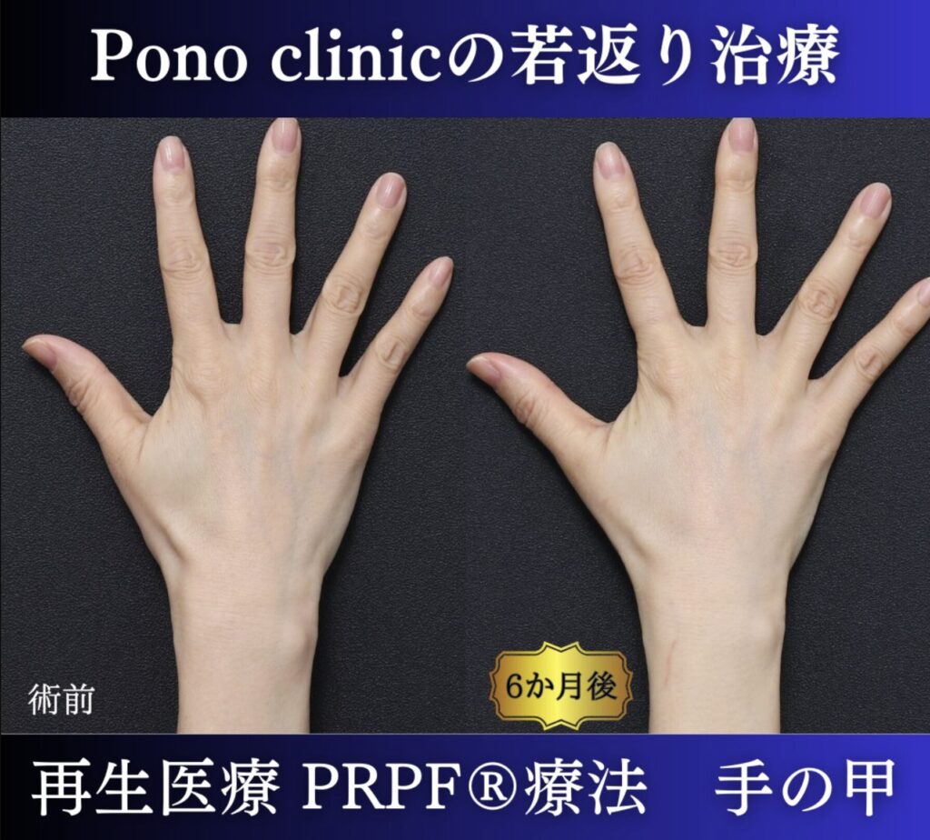 手の甲のアンチエイジング、PRPF療法、50代の症例 (1)