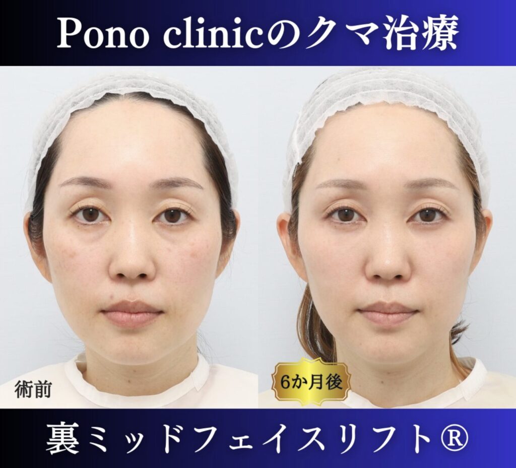 目の下のクマ取り、裏ハムラ、40代女性の症例 (7)