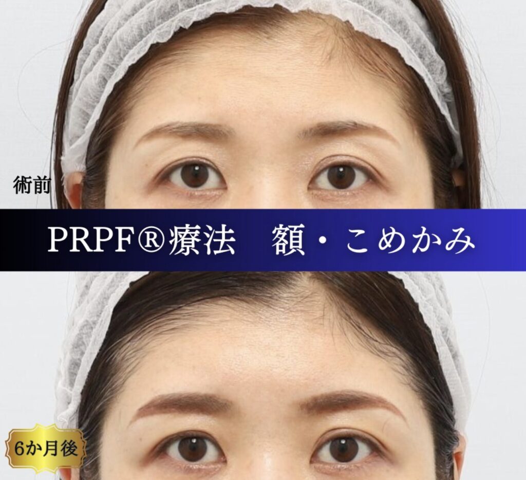 額、こめかみ、PRPF療法の症例 (3)