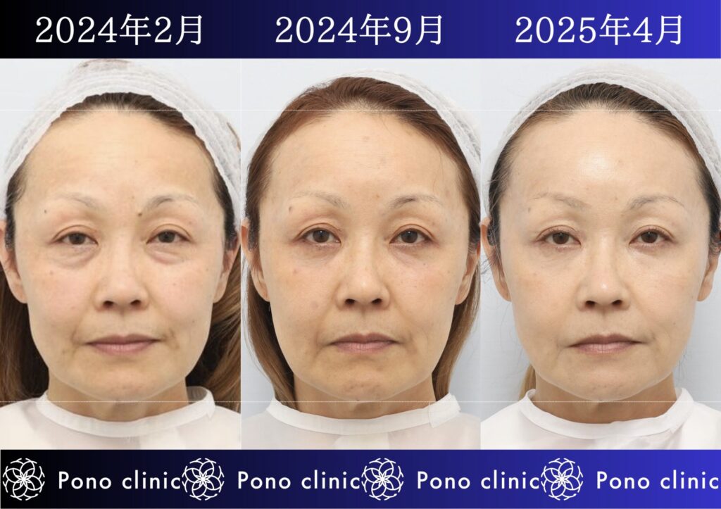 50代女性の症例、目の下のクマ、シワ治療、法令線治療 (1)