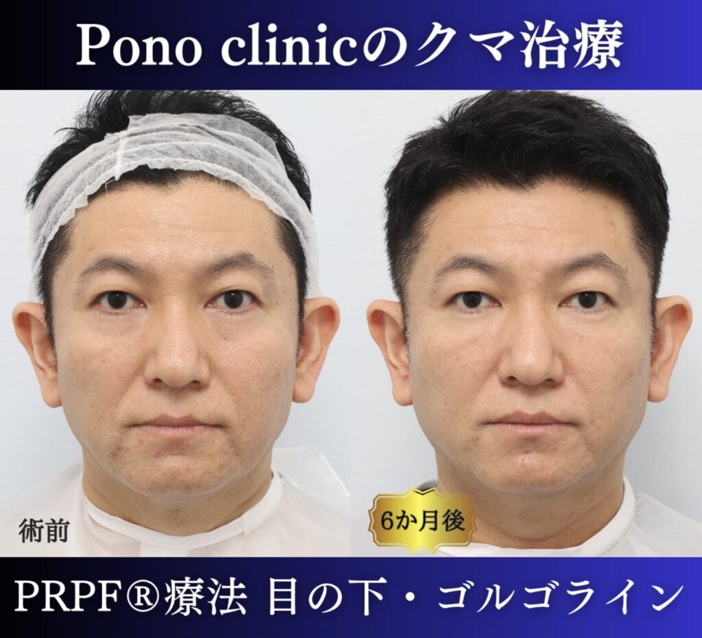 50代男性の症例、目の下のクマ改善、PRP注射 (4)