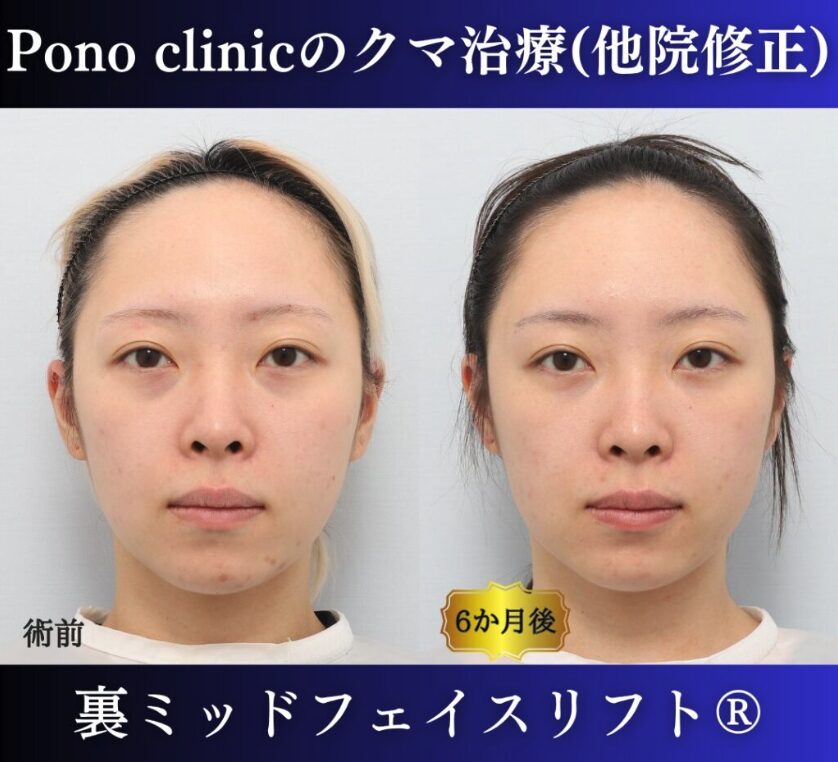 20代女性の症例、脱脂後の修正、裏ハムラ、目の下のクマ取り (10)