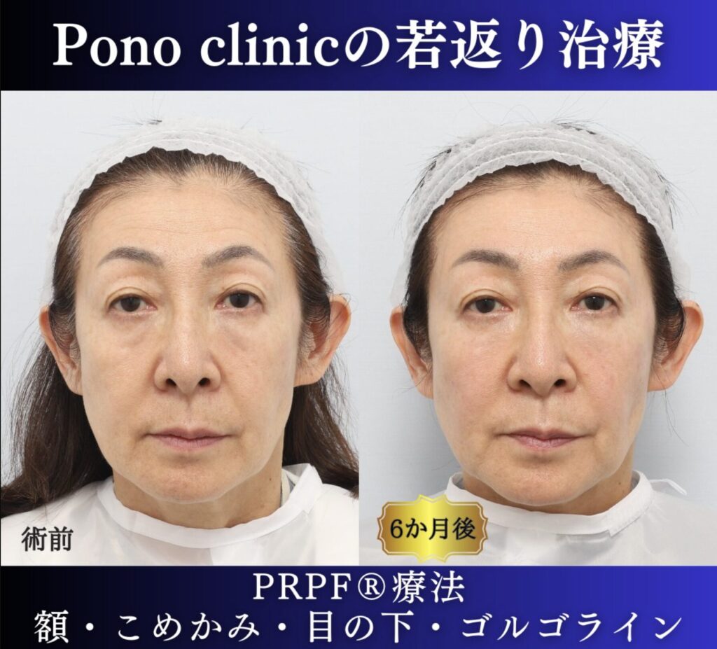 60代女性の症例、PRP注射、目の下のクマ、額形成 (5)