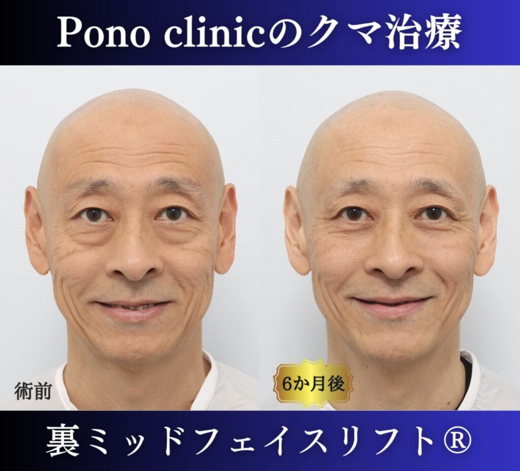 男性のクマ取り手術、裏ミッドフェイスリフト®、50代の症例 (4)