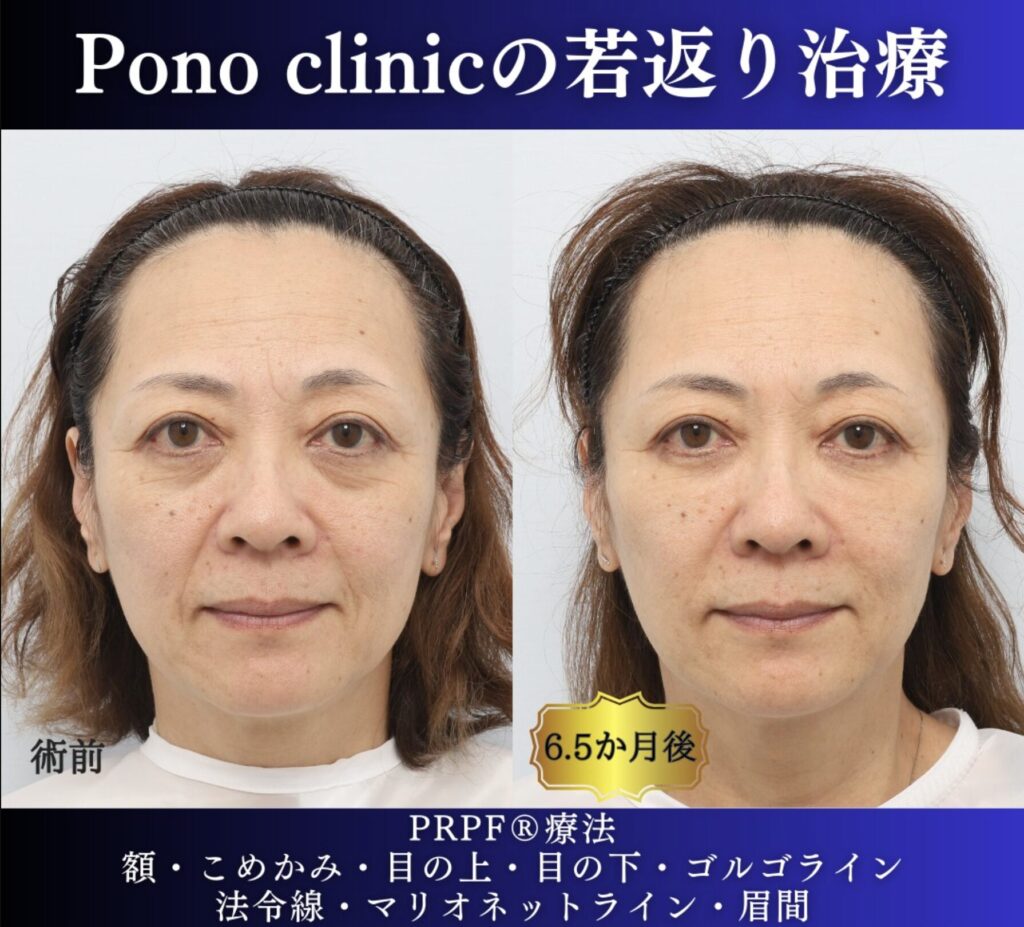 50代女性の症例、しわ取り、目の下のクマ取り、再生注射 (6)