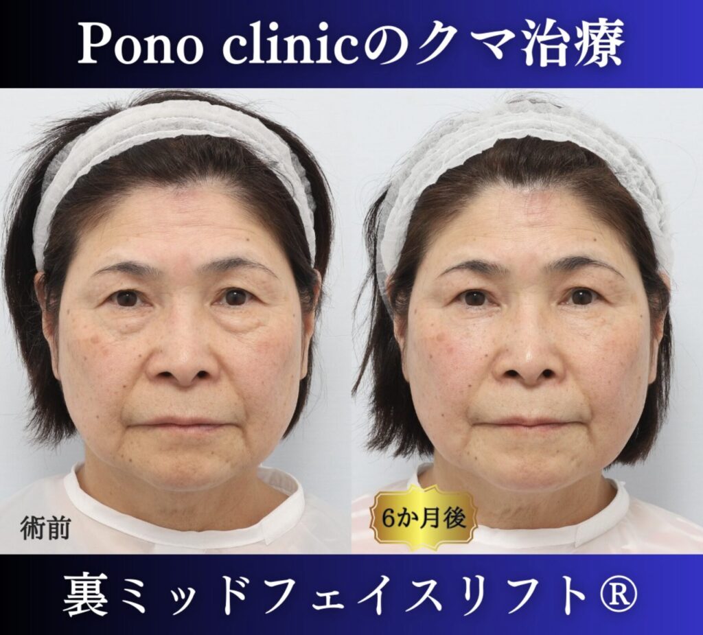 目の下のたるみ、クマ取り、60代女性の症例 (8)