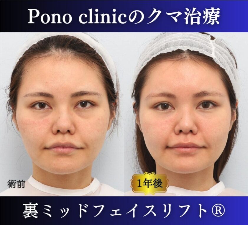 30代女性の症例、目の下のクマ取り、裏ハムラ、裏ミッドフェイスリフト (6)