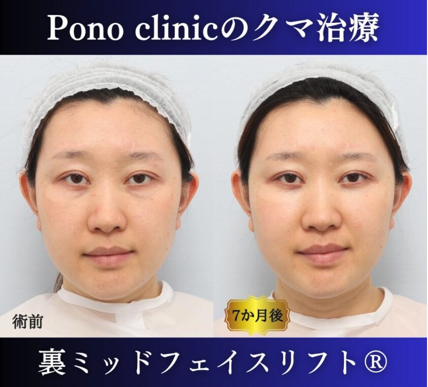 30代女性の症例、目の下のクマ取り、裏ハムラ法、ミッドフェイスリフト (6)