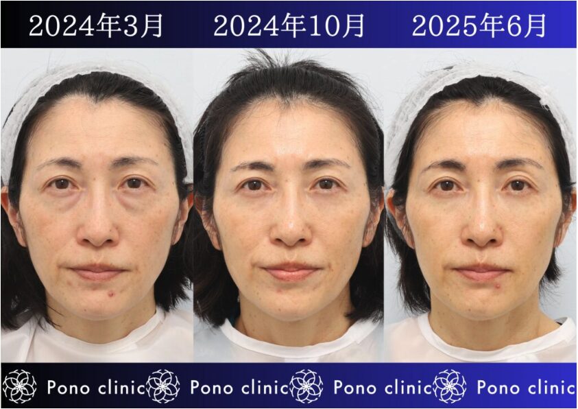 50代女性の症例、アンチエイジング治療、目の下のクマ取り、しわ治療、裏ハムラ法、PRP (6)