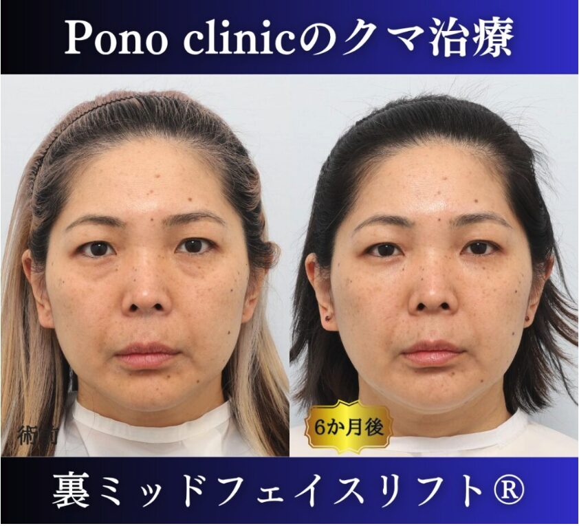 40代女性のクマ治療、目の下のクマ取り、裏ハムラ法、ミッドフェイスリフト (7)