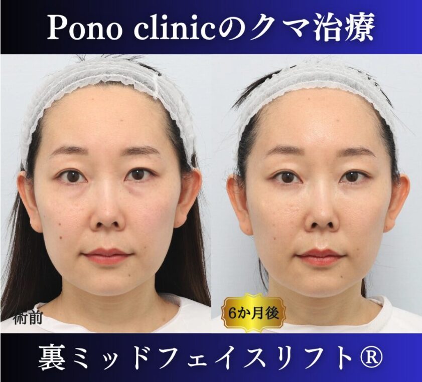 裏ミッドフェイスリフト