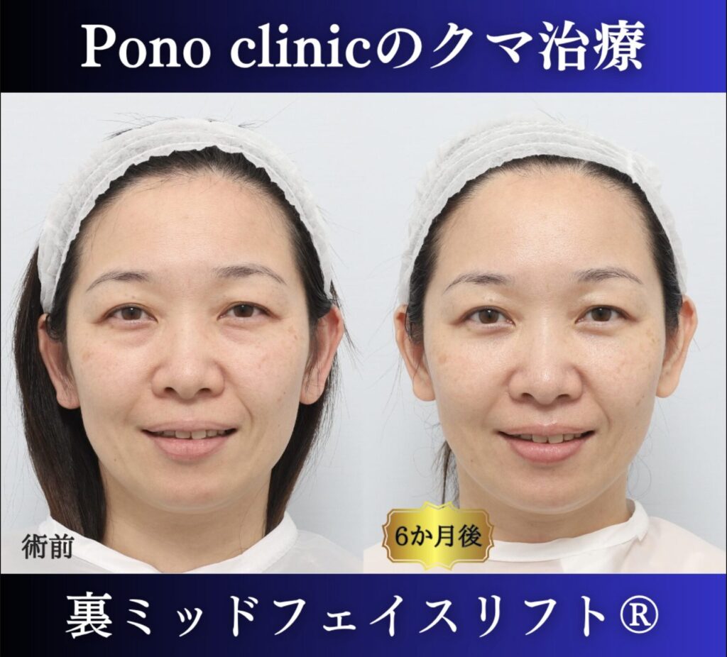 40代女性、目の下のクマ、裏ハムラ法、クマ取り　新宿、裏ミッドフェイスリフト (4)