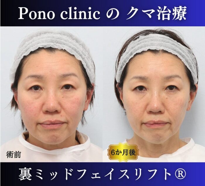 50代女性、目の下のクマ取り、裏ハムラ、ミッドフェイスリフト (6)