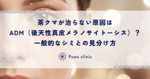 茶クマが治らない原因はADM（後天性真皮メラノサイトーシス）？一般的なシミとの見分け方